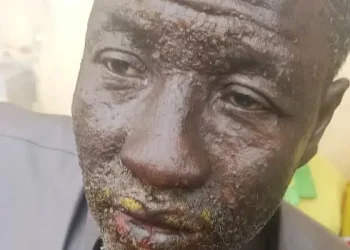 Alerte : 7 pêcheurs mystérieusement brûlés en mer hospitalisés à Conakry