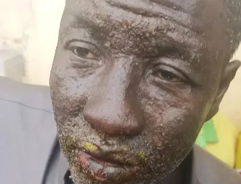 Alerte : 7 pêcheurs mystérieusement brûlés en mer hospitalisés à Conakry