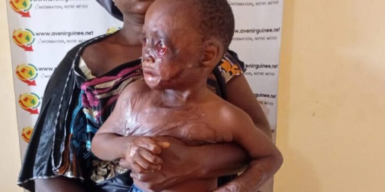 Maxime Kolié un enfant de 2 ans en souffrance après un accident, ses parents demandent de l&rsquo;aide