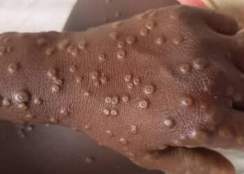 Guinée : Sept épidémies simultanées menacent 13 districts sanitaires